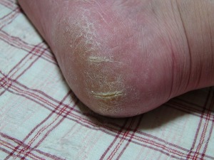 別の意味で「もち肌」